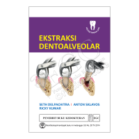 Ekstraksi dentoalveolar